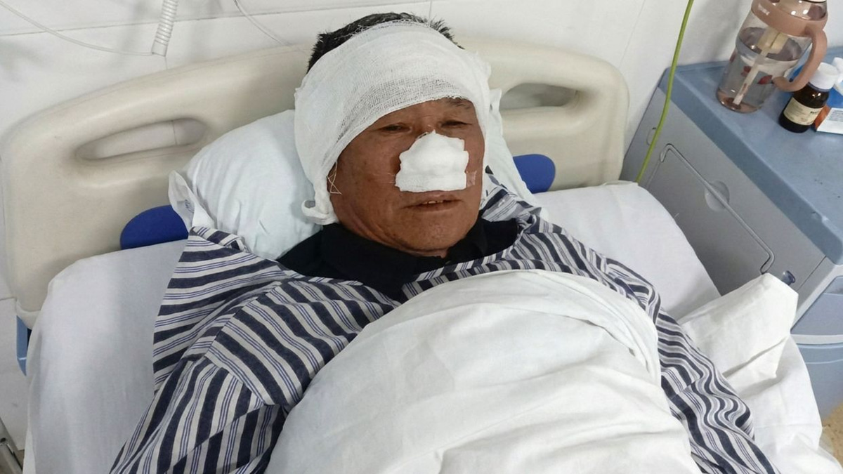 Chinese Village Hero Loses Nose Saving Woman From Attacker, Honoured Nationally