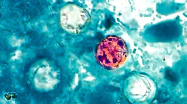 The Invisible Threat: Why Cyclospora Outbreaks Are So Hard to Stop
