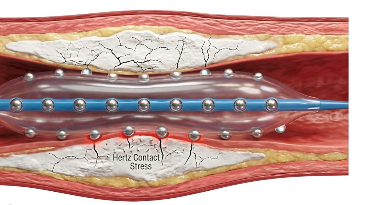 Malaysian cardiologists pioneer advanced treatment for hardened heart artery blockages