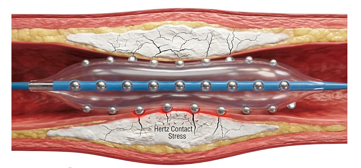 Malaysian cardiologists pioneer advanced treatment for hardened heart artery blockages